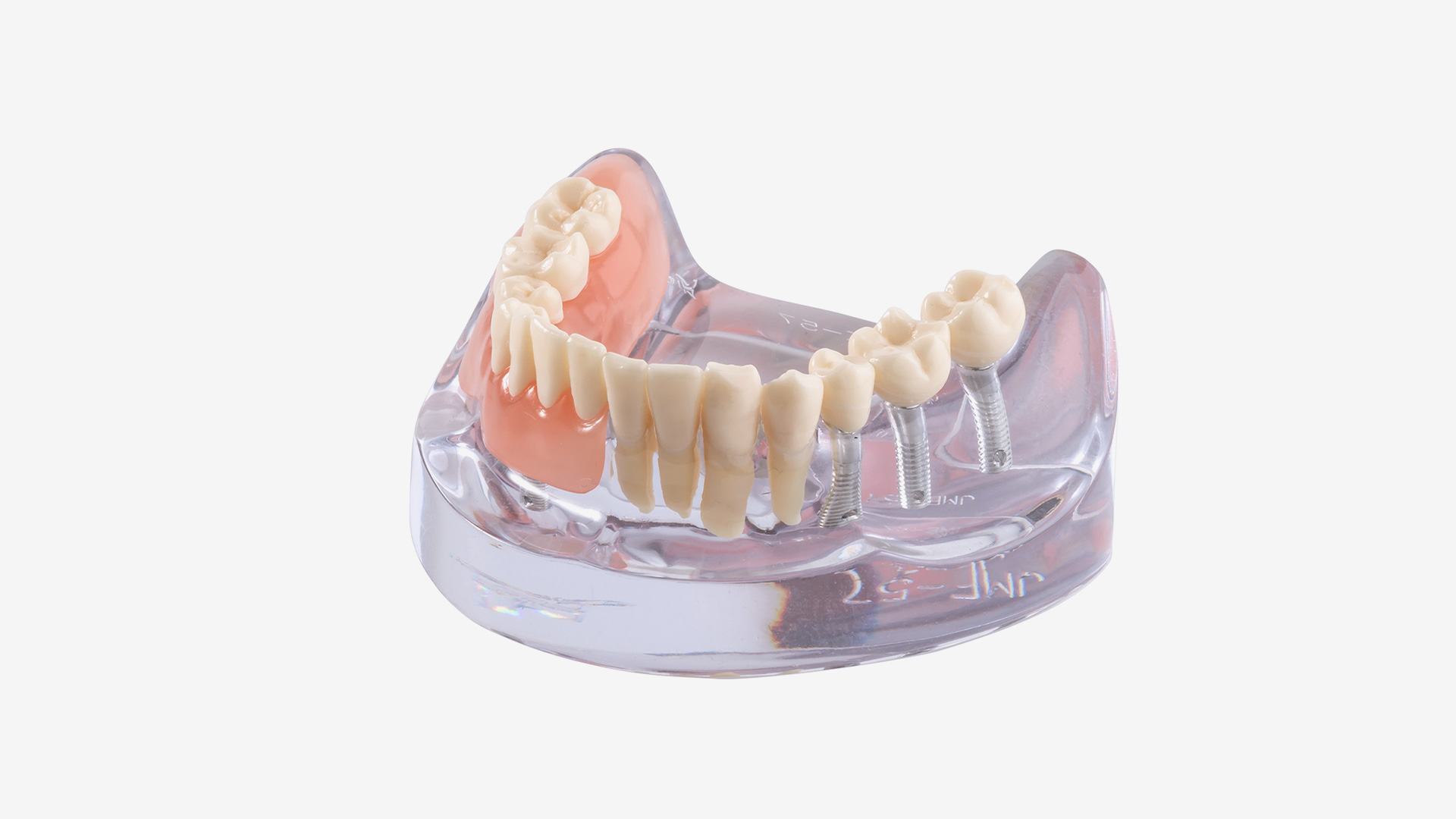 iP12-SB11 Implantatmodell UK mit Prothesen