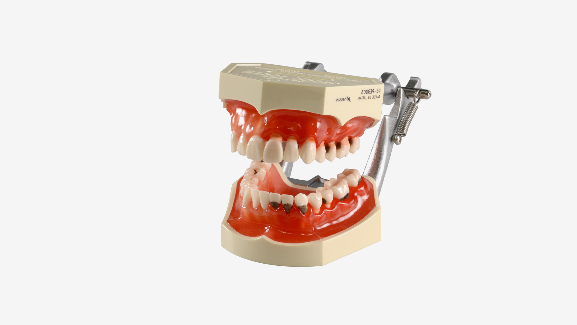 P2D-001 Parodontiemodell mit Karies